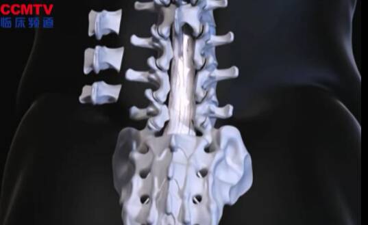 脊髓室管膜瘤（后入路 - 3D模拟）